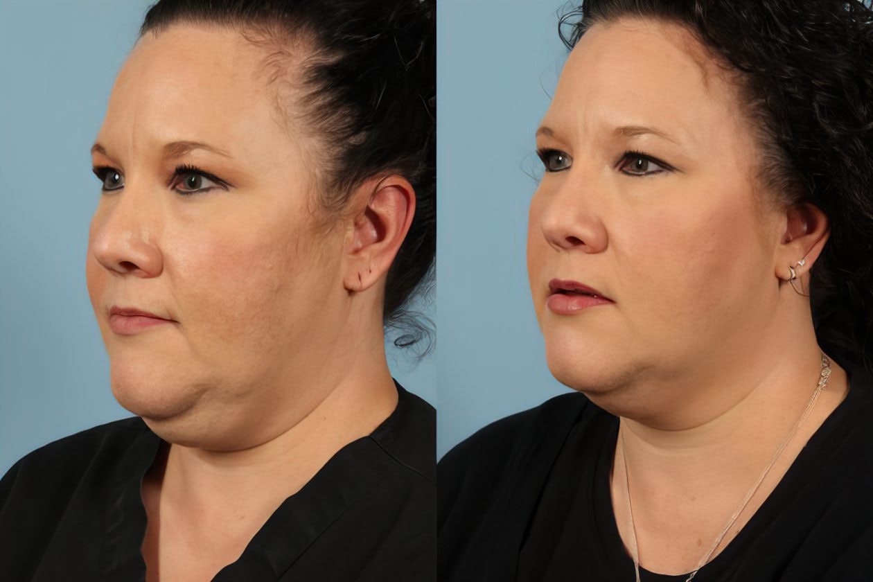 Angled view of Case 6's CoolSculpting