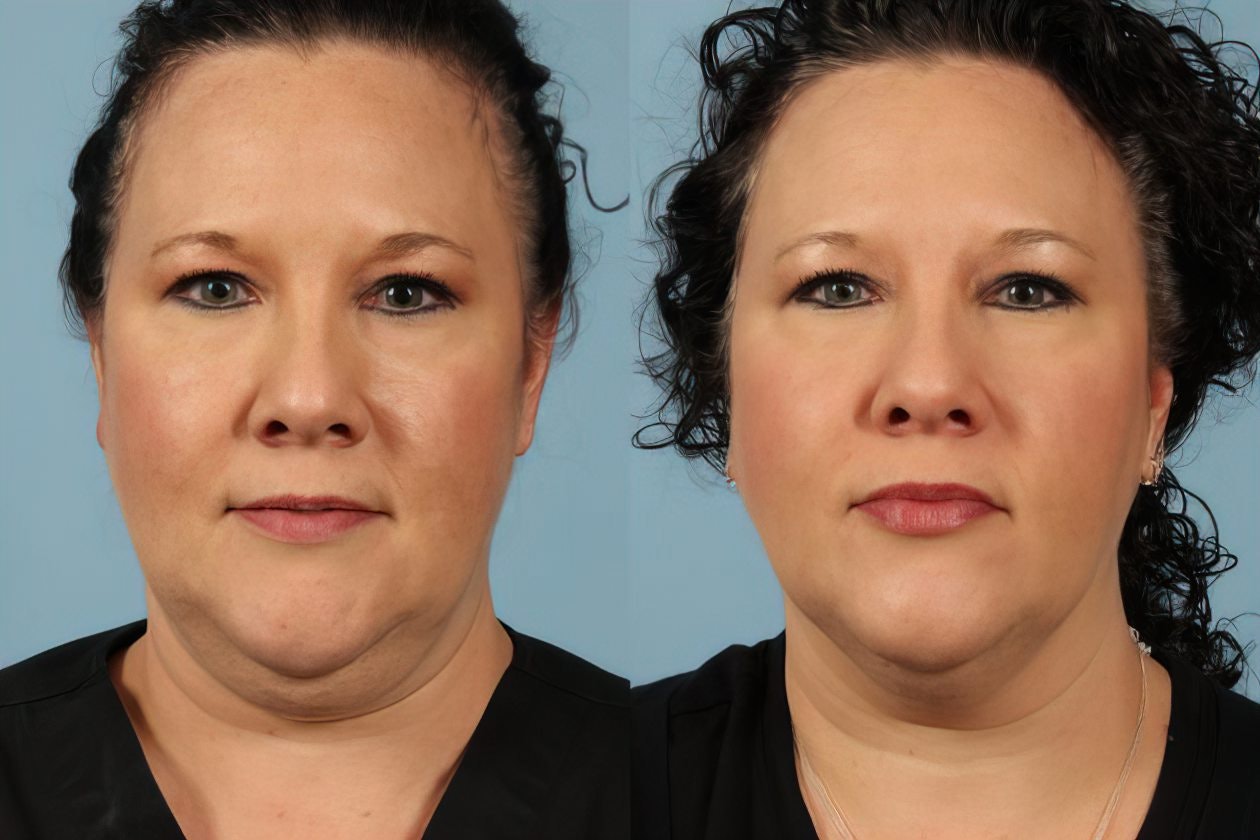 Front view of Case 6's CoolSculpting