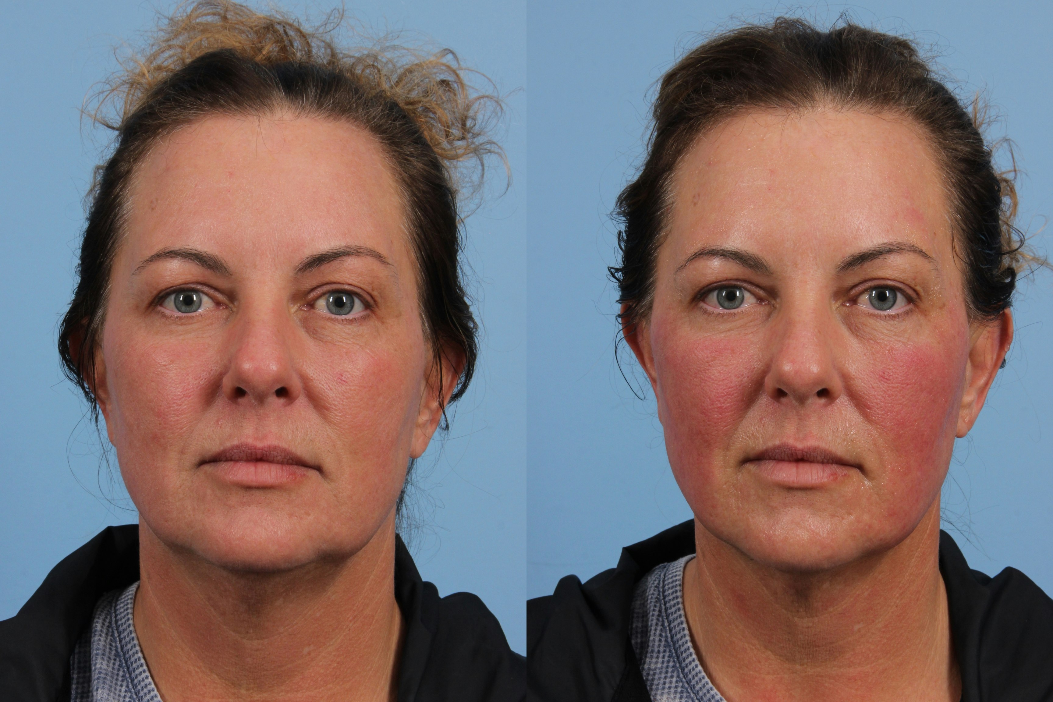 Front view of triLift patient