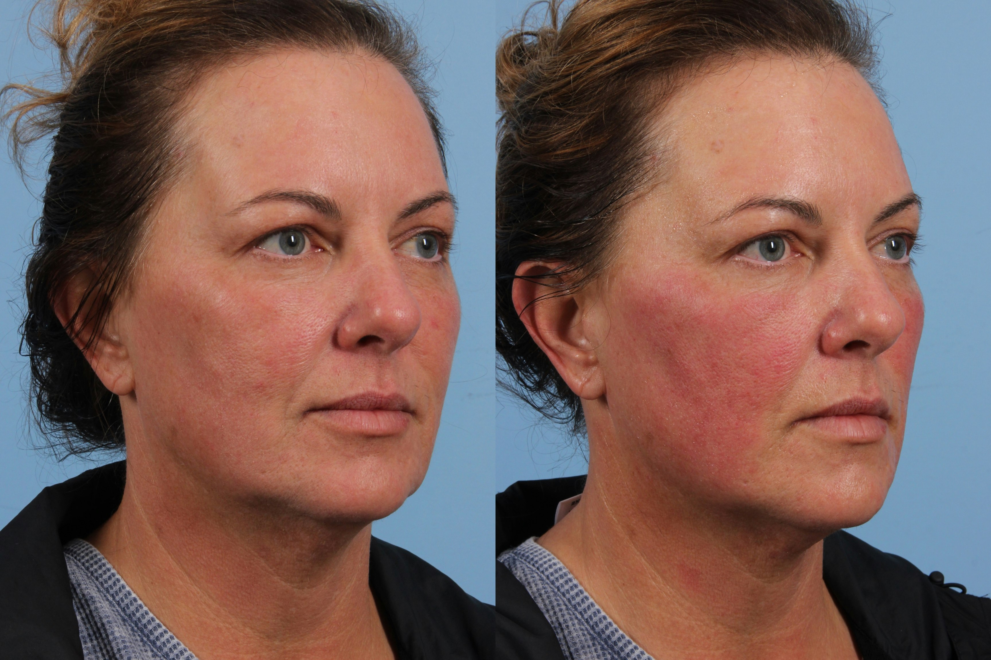 Angled view of triLift patient