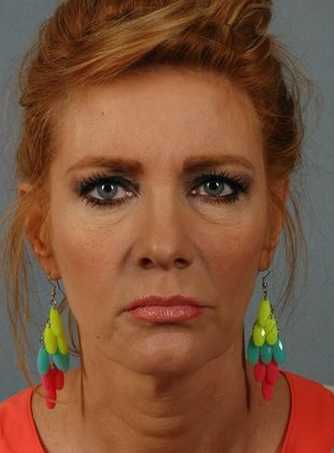 Woman before dermal fillers