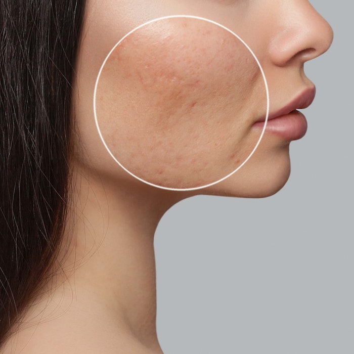 Woman with acne scars