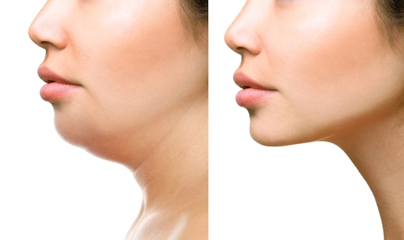 KYBELLA results