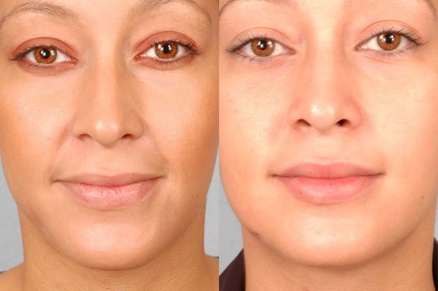 before and after lip augmentation