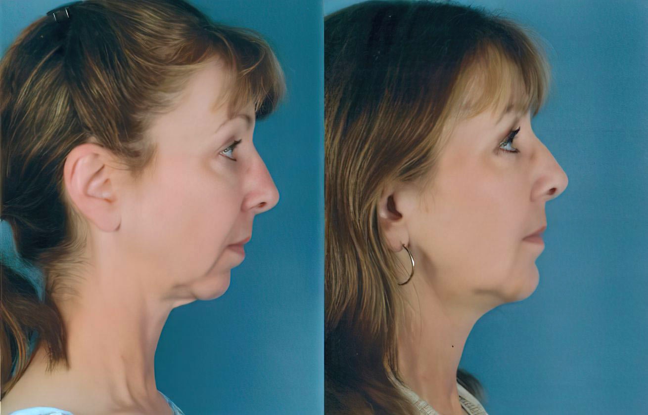 Case 2 Before and After Chin Augmentation