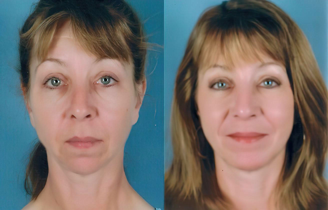 Case 2 Before and After Chin Augmentation