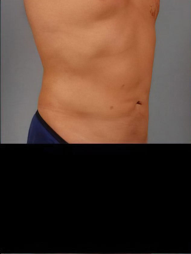After liposuction