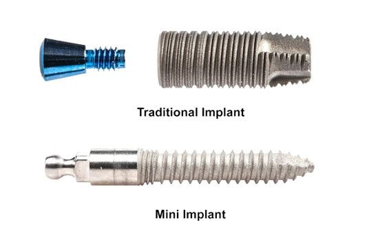 Traditional versus Mini Implants