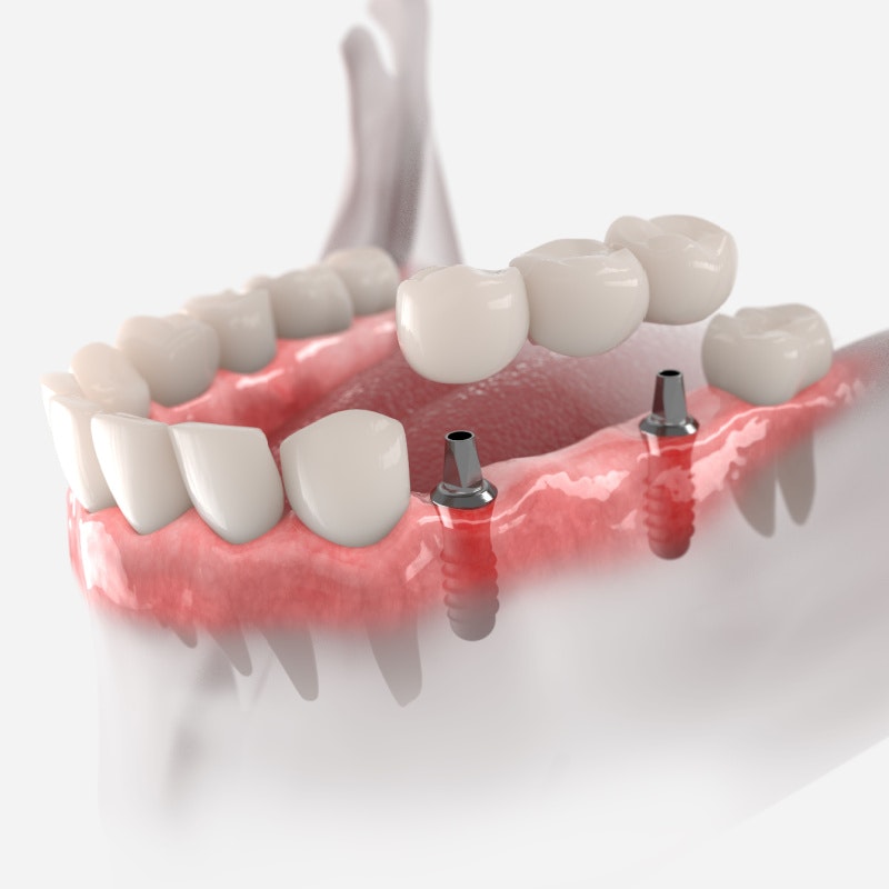 Implant bridge