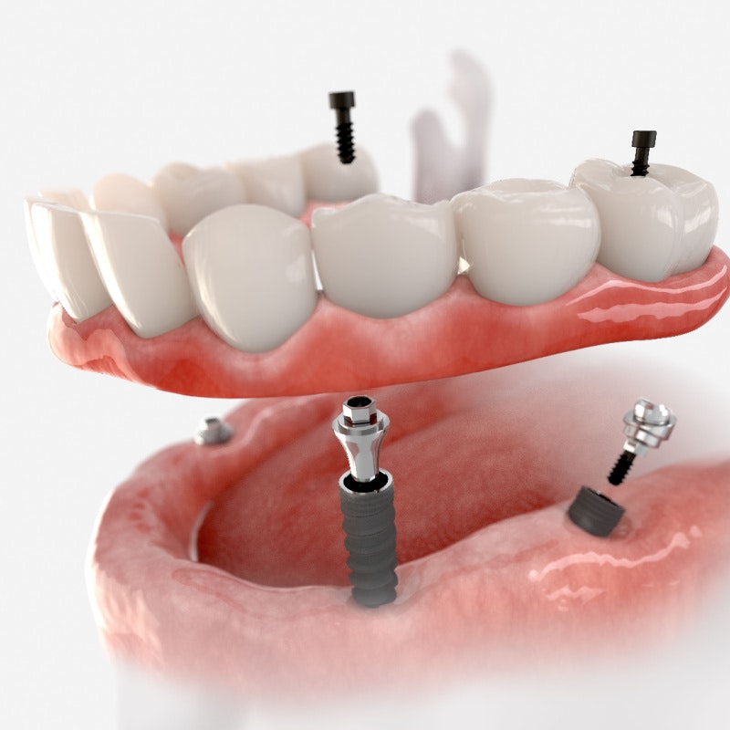 Implant denture