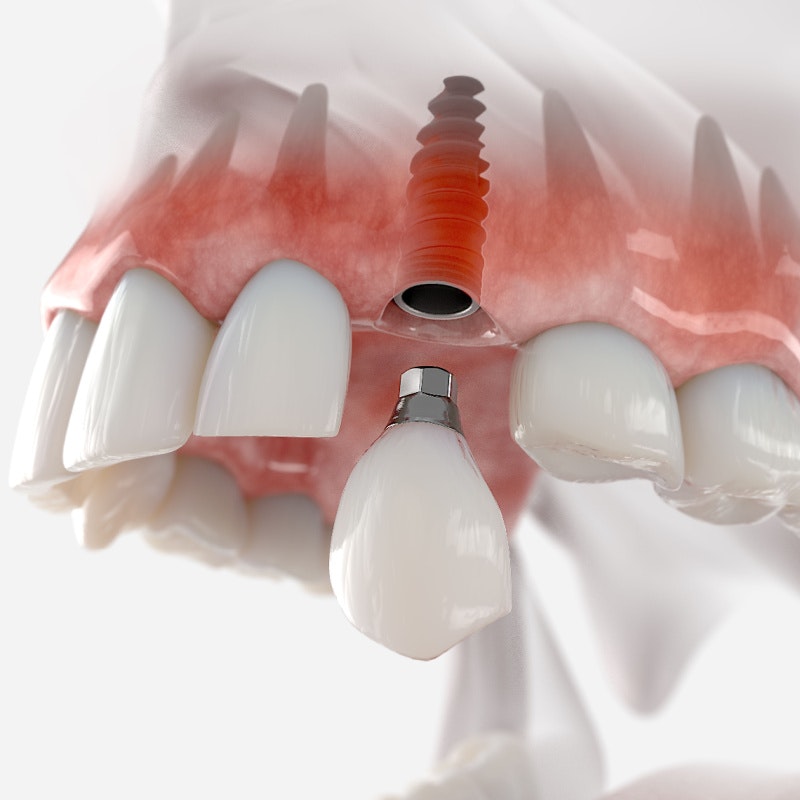 Implant crown