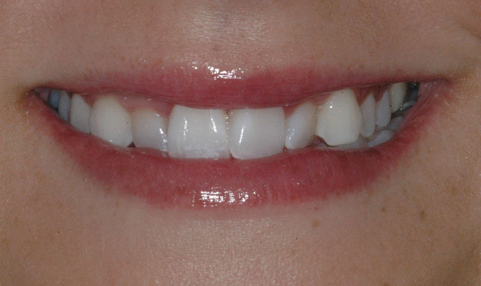 Dr. Gerald Lande's patient before orthodontics