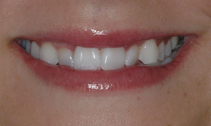 Dr. Gerald Lande's patient before orthodontics
