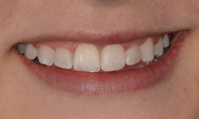 Dr. Gerald Lande's patient after orthodontics