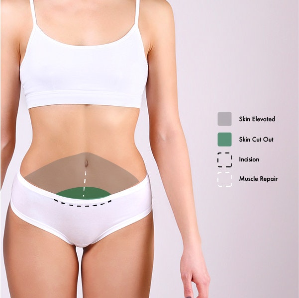 Mini Tummy Tuck model