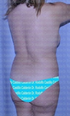 Before patient received liposuction and a bbl