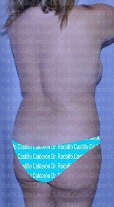 Before patient received liposuction and a bbl