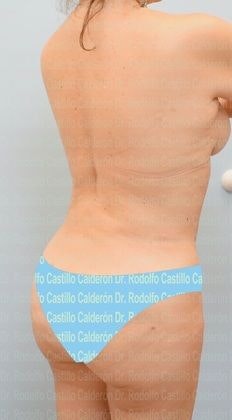 After patient received liposuction and a bbl