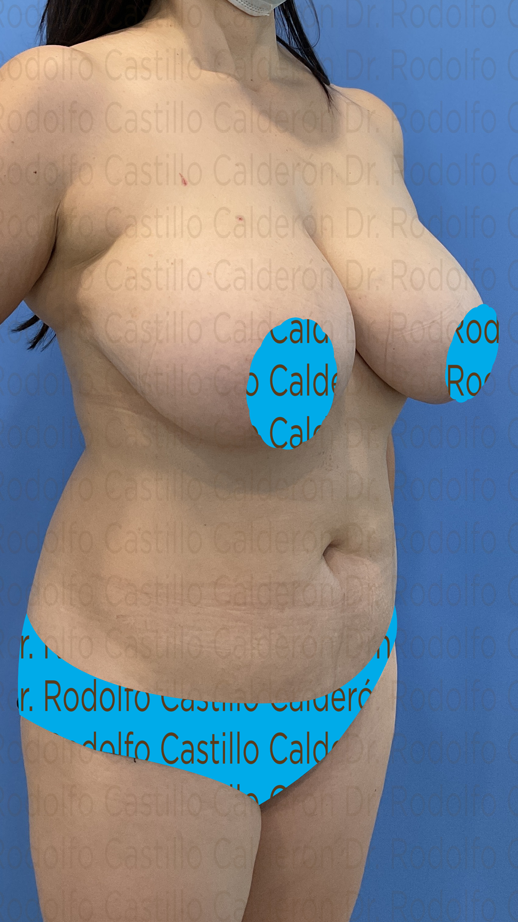Upper Body Lift – Tijuana, Mexico – San Diego, CA – Breast Lift