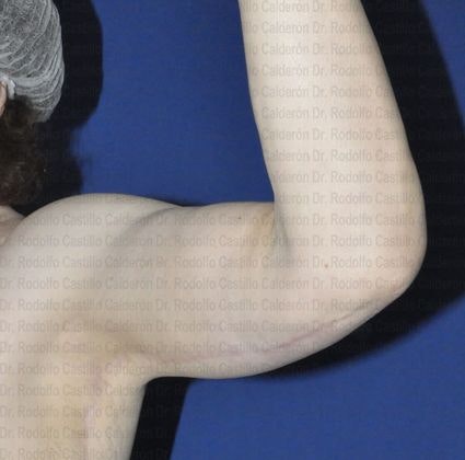 Dr. Rodolfo Castillo Calderón's patient after extended Arm Lift