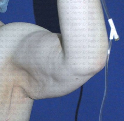Dr. Rodolfo Castillo Calderón's patient before extended Arm Lift
