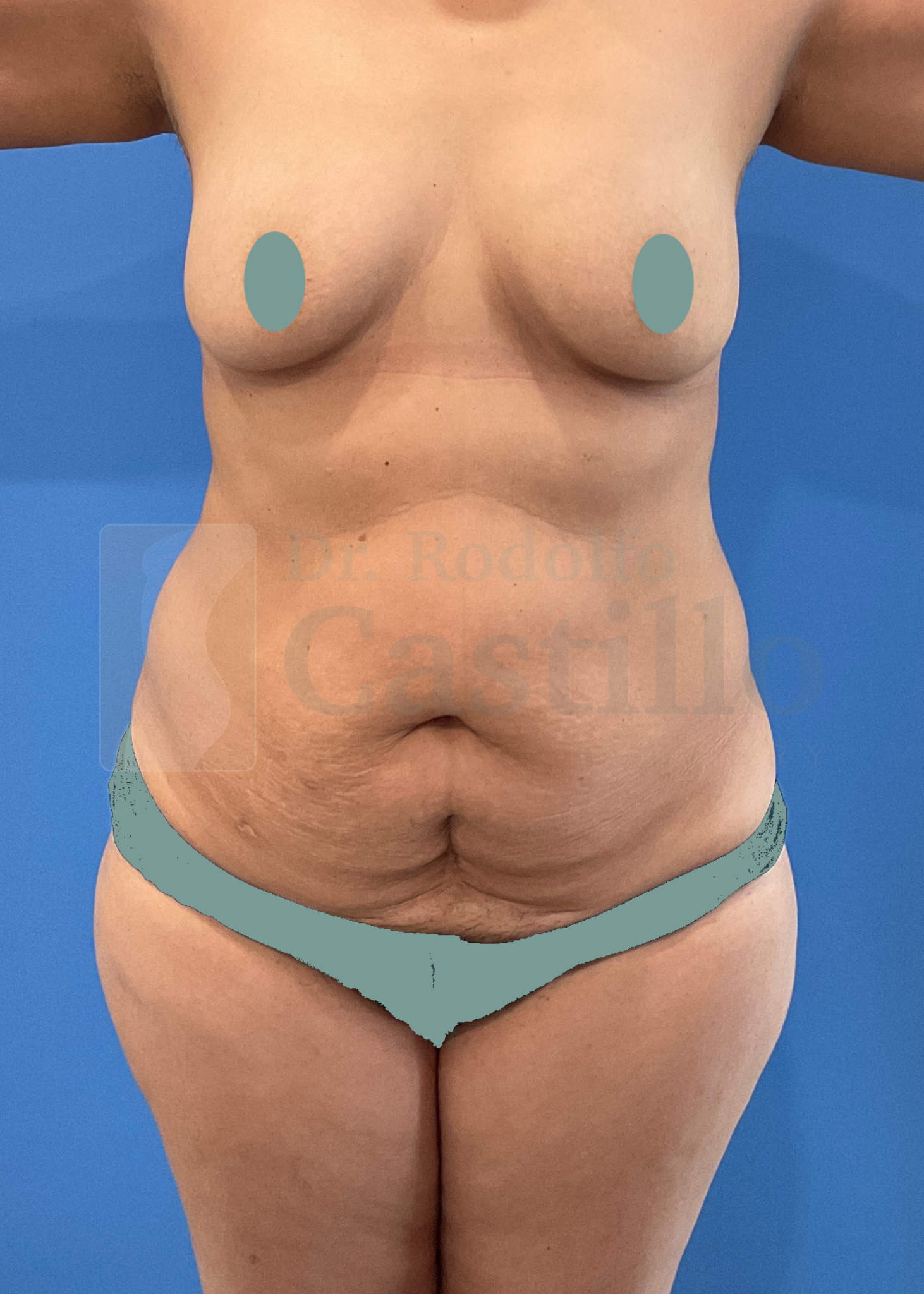 Patient before Mommy Makeover