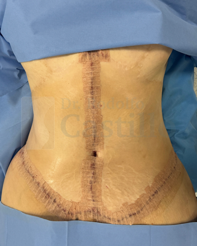 Dr. Rodolfo Castillo's patient after belt lipectomy