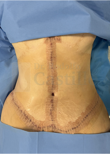 Dr. Rodolfo Castillo's patient after belt lipectomy