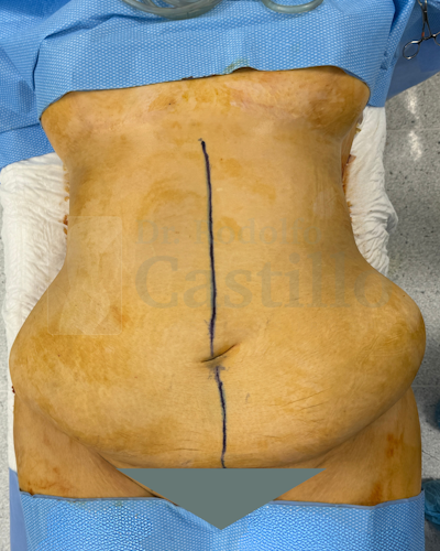 Dr. Rodolfo Castillo's patient before belt lipectomy