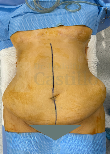Dr. Rodolfo Castillo's patient before belt lipectomy