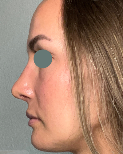 after rhinoplasty