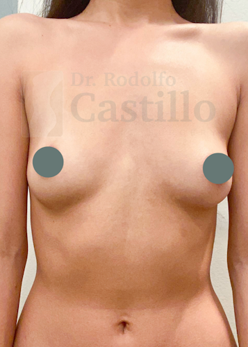 Before breast implants