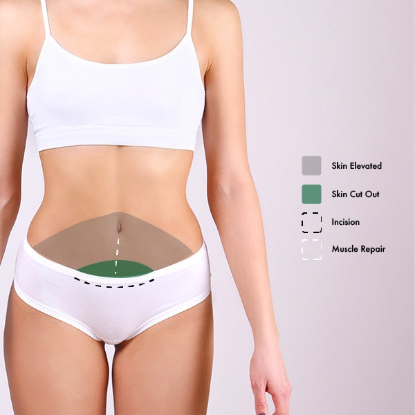 Mini Tummy Tuck model