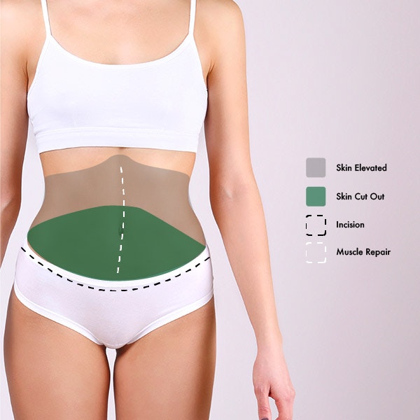 Extended Tummy Tuck diagram