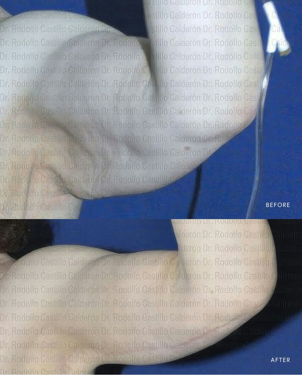 Real patient before and after an arm lift