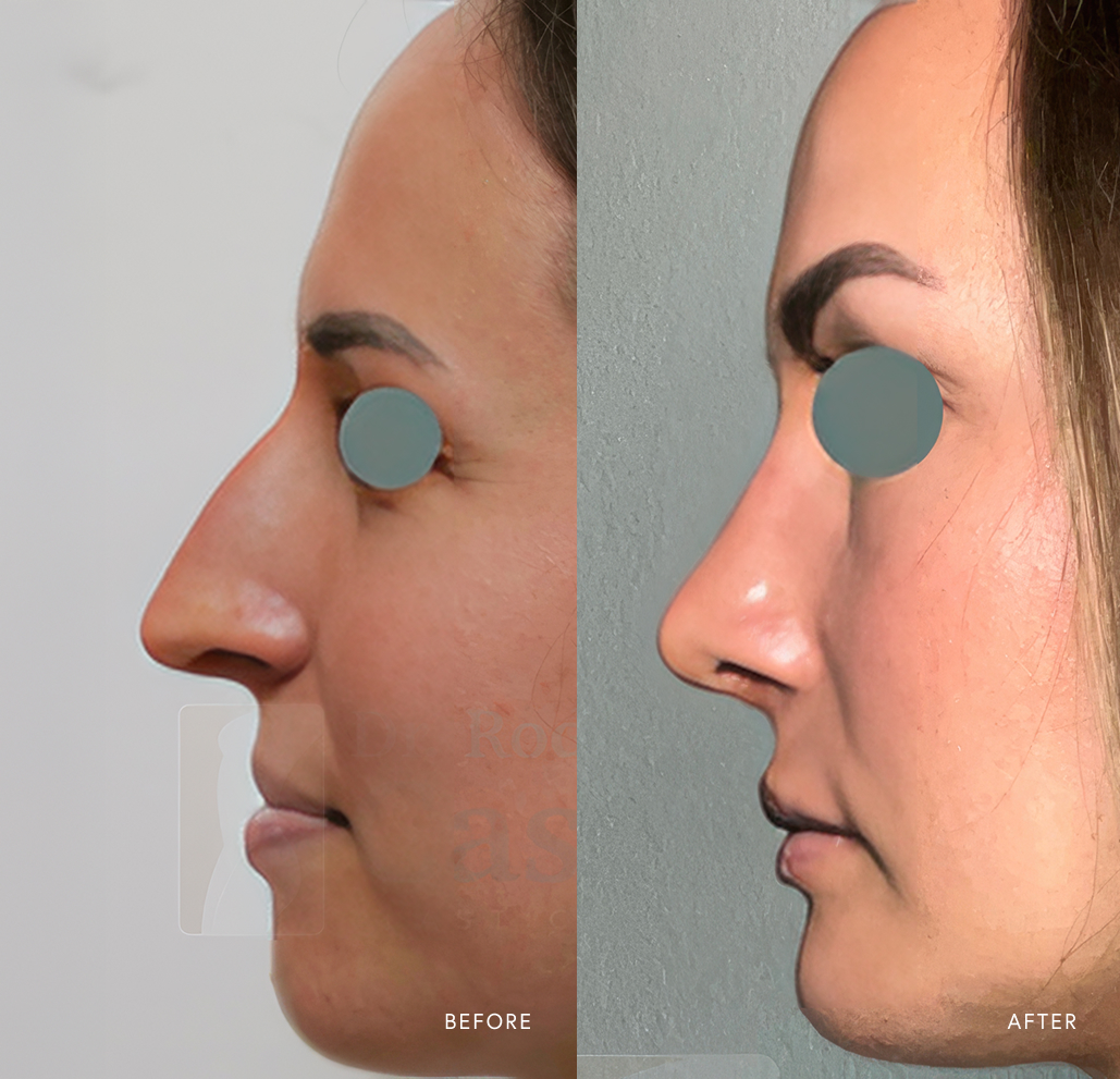 Before and after rhinoplasty