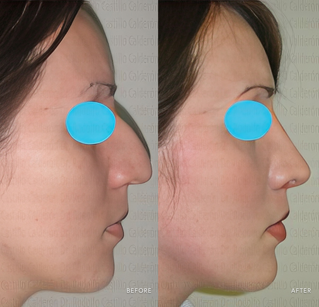 Before and after rhinoplasty
