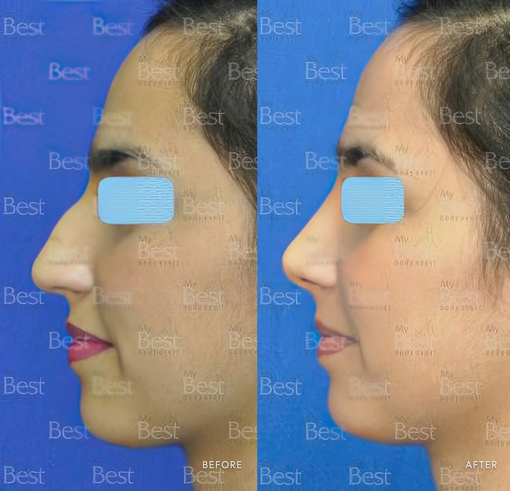 Before and after rhinoplasty