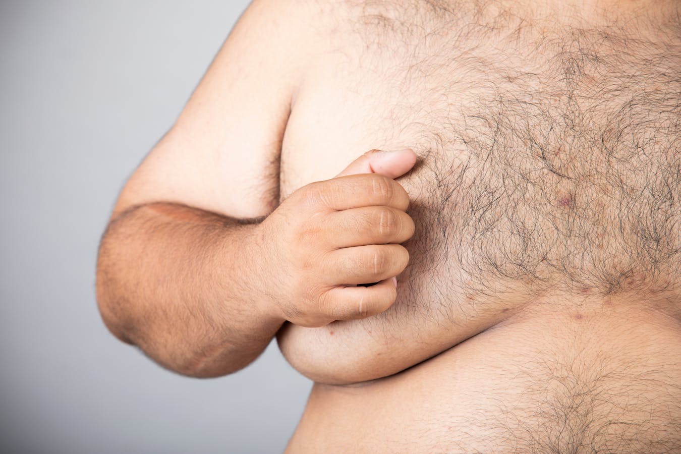 man with gynecomastia