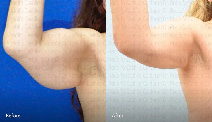 before and after brachioplasty