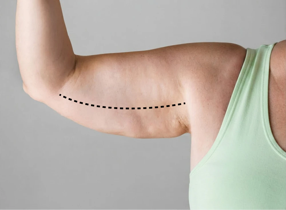 standard arm lift incision pattern