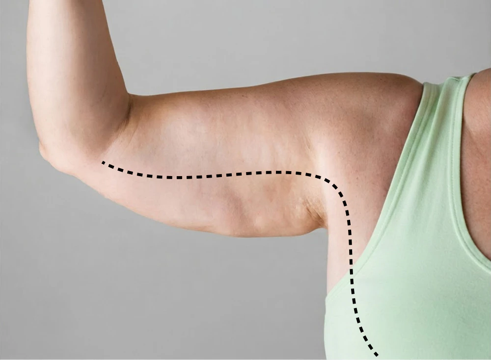 extended arm lift pattern