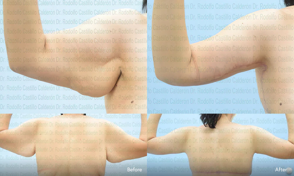 patients with before and after arm lifts