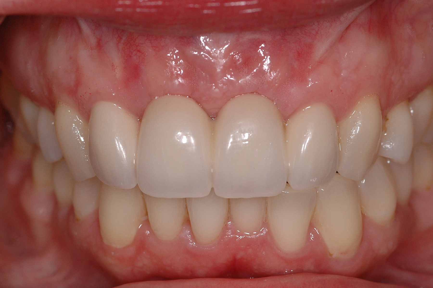 Dental Bonding - Glastonbury, CT - Hartford, CT - Dr. Avinash Bidra