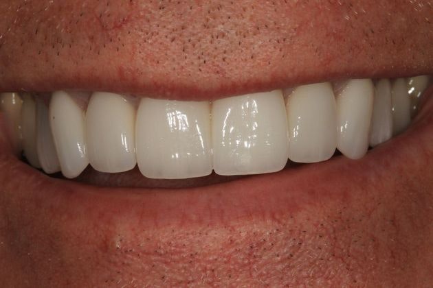 After Smile Makeover