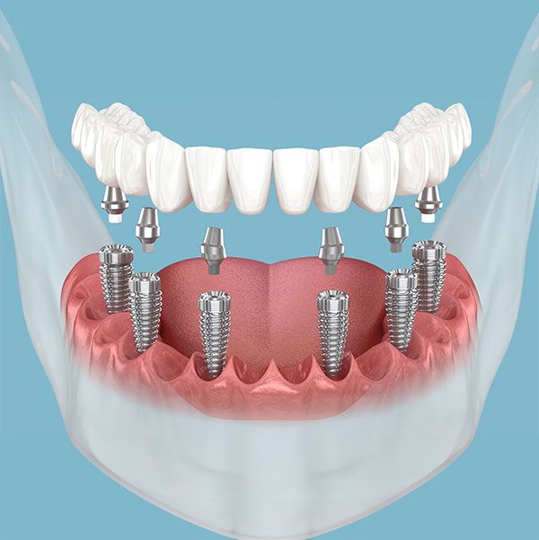 Implant-supported-denture
