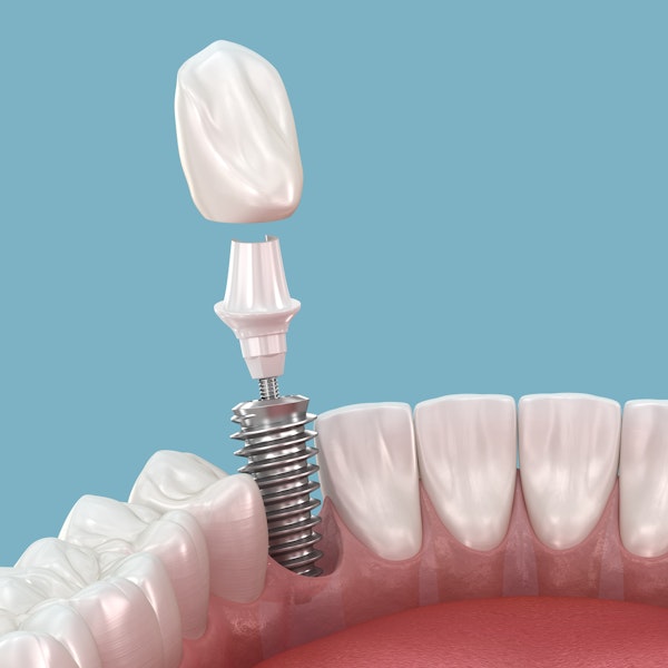 Implant-supported-crown