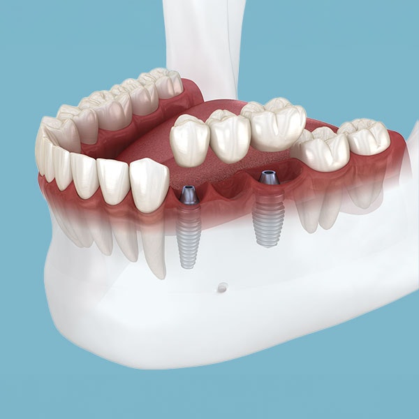 Dental Bridges