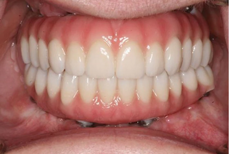Advanced Cosmetic and Implant Dentistry — All-on-4 dental implants