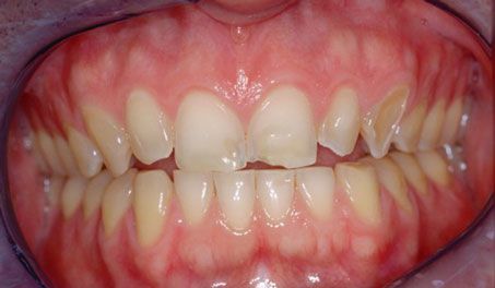 Dr. Bidra's patient before veneers